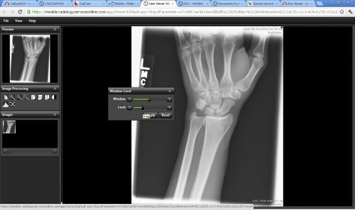 RSO_Hand_xray