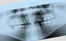 dental_xray